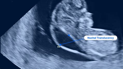 increased nuchal fold prenatal ultrasound